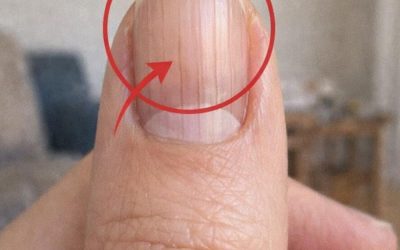 Un medico scopre un segno rivelatore nelle unghie che potrebbe predire la tua aspettativa di vita
