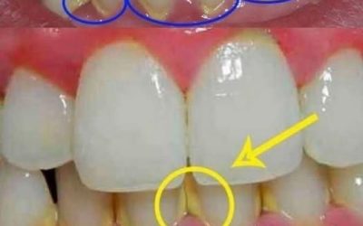 Rimuovi la placca in 5 minuti in modo naturale, senza andare dal dentista