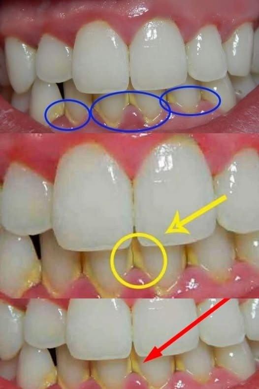 Rimuovi la placca in 5 minuti in modo naturale, senza andare dal dentista