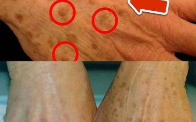 La migliore vitamina per la rimozione delle macchie dell’età