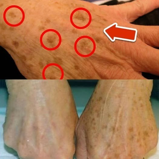 La migliore vitamina per la rimozione delle macchie dell’età