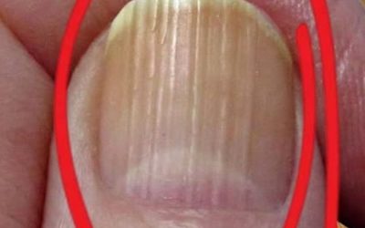 Cosa possono rivelare le linee verticali sulle unghie sull’invecchiamento