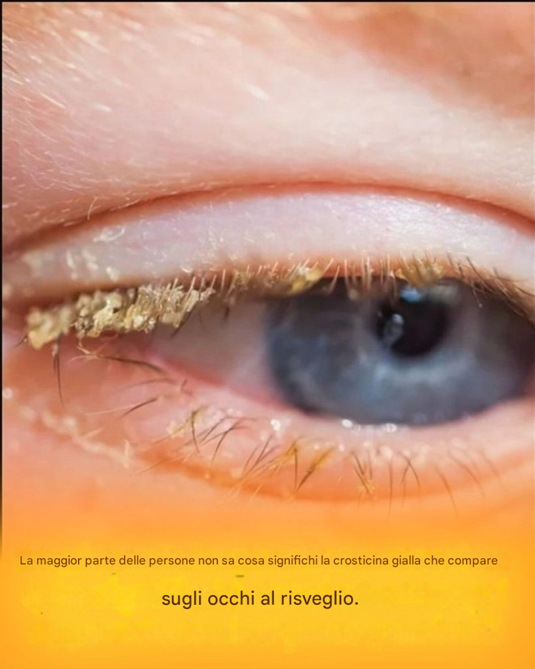 Crosta gialla al risveglio: cosa significa?