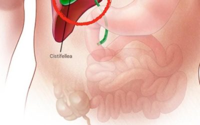 Cosa succede al corpo dopo la rimozione della cistifellea? 3 patologie che possono insorgere: se possibile, evitate l’intervento chirurgico.