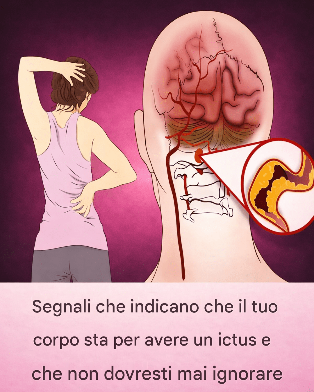 10 segnali precoci di ictus che tutti dovrebbero conoscere per intervenire tempestivamente
