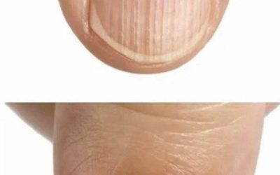 Il dottore spiega cosa significano le creste sulle unghie